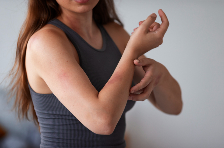 Eczema (Dermatitis)